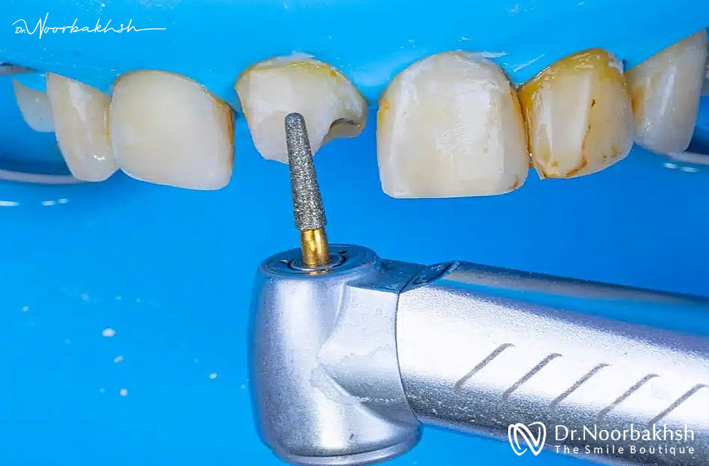 استفاده از تکنیک اسید اچینگ انتخابی