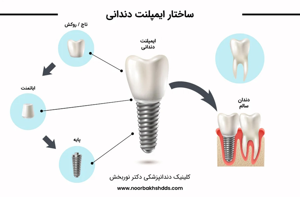 ساختار ایمپلنت دندان