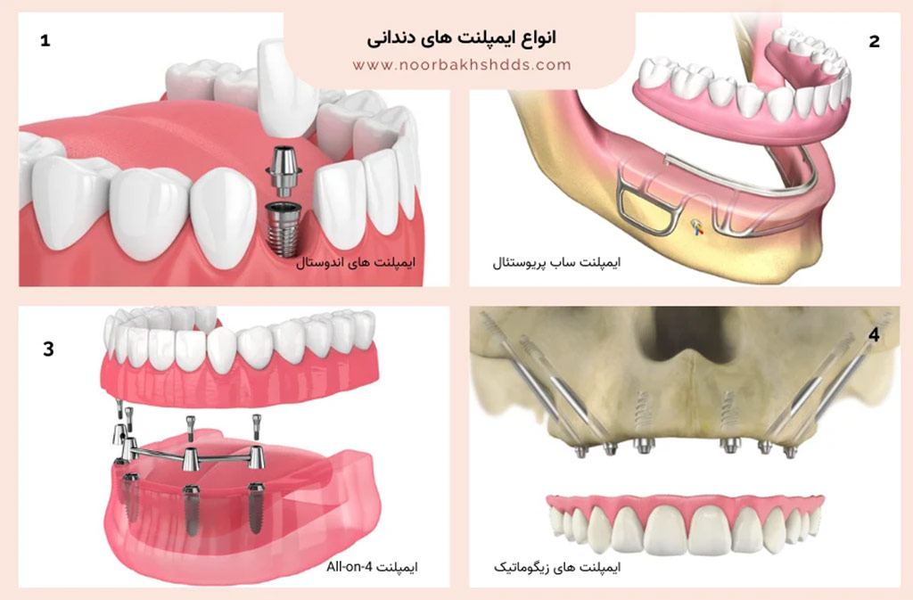 انواع ایمپلنت دندان